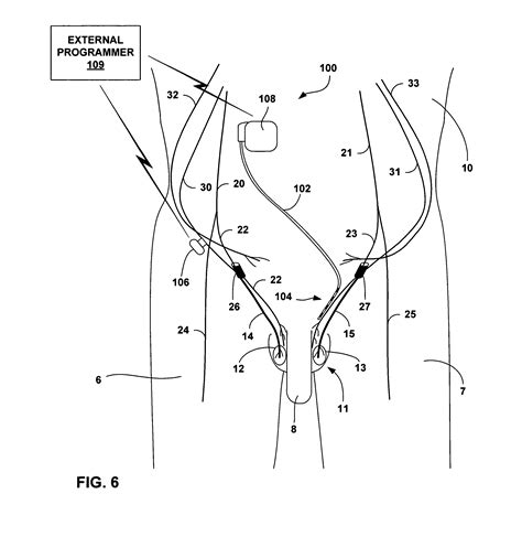 Patent Us8219202 Electrical Stimulation Of Ilioinguinal