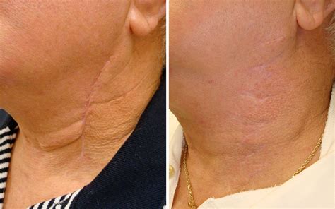 scar removal  scottsdale