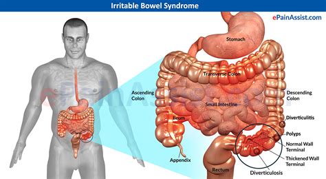 irritable bowel syndrome ibs treatment symptoms signs types