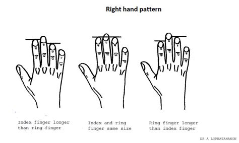 Bbc Fergus S Medical Files Can Finger Length Predict Your Risk Of