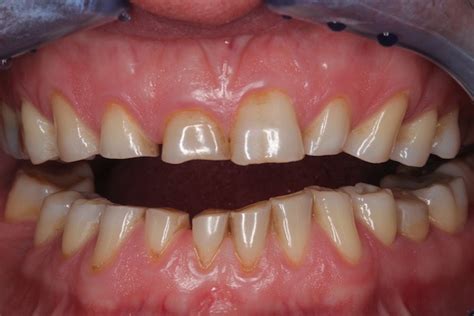 slijtage beginsituatie dr  visser tandarts