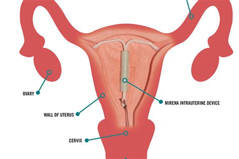 contraception the intra uterine device news critic te