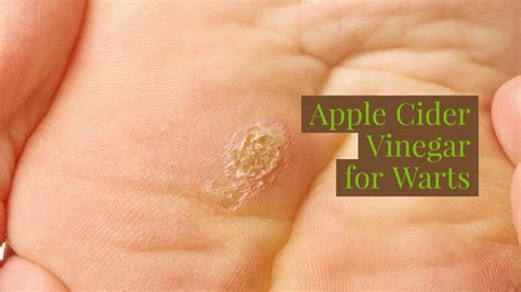 apple cider vinegar for removing warts