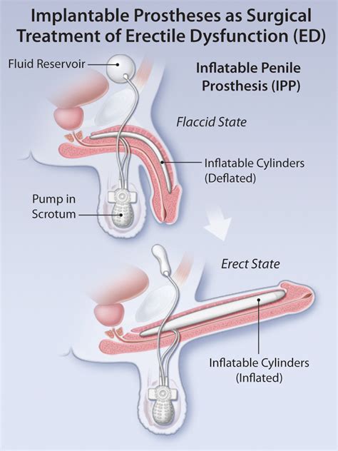 invasive treatments of erectile dysfunction ed
