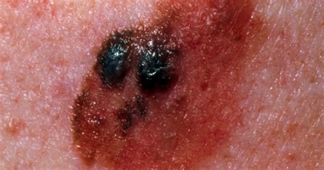 stage  melanoma survival rate pictures  treatment