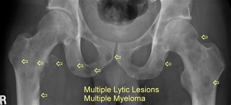 multiple myeloma  plasmacytoma