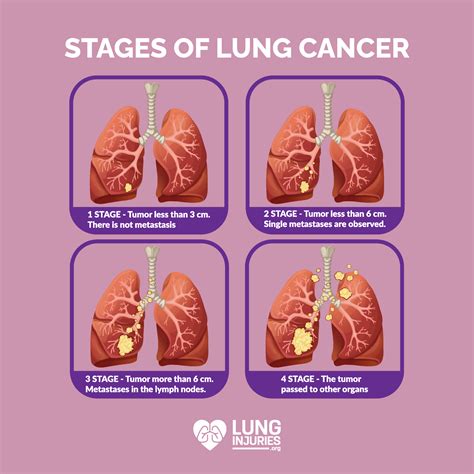lung cancer symptoms signs    pritish