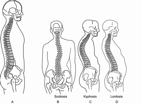 abnormal spine curvatures chiropractic healing center