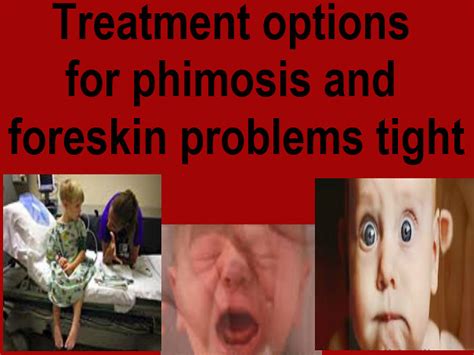 Treatment Options For Phimosis And Foreskin Problems Tight A Photo On