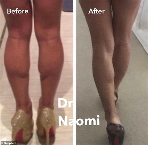 Woman 29 Has 1 500 Treatment To Slim Down Her Calf Muscles Daily