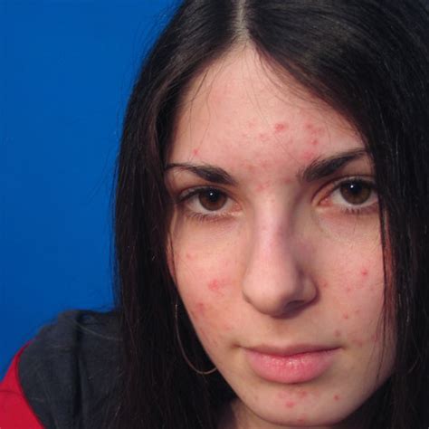 skin  facial treatments   prevent pimples