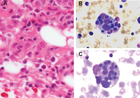 frontiers hemophagocytic lymphohistiocytosis   etiology  bone