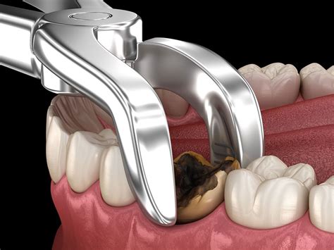 wisdom teeth extraction process cost break down omega dental houston tx