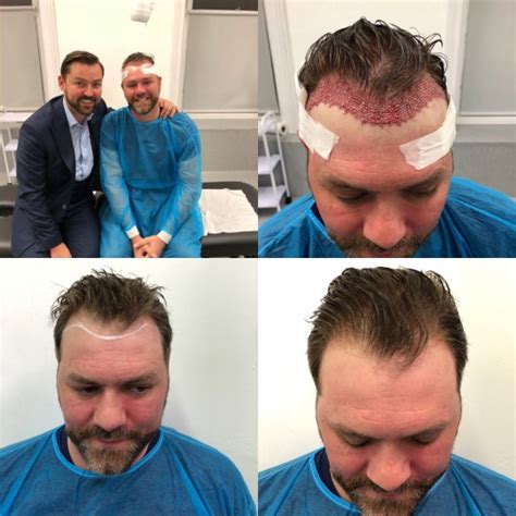Westlife Singer Brian Mcfadden Reveals Gruesome Hair Transplant Photos