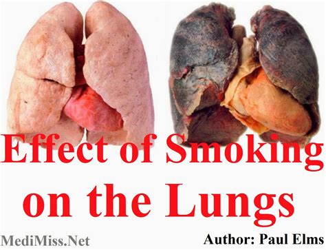 effect  smoking   lungs medimiss