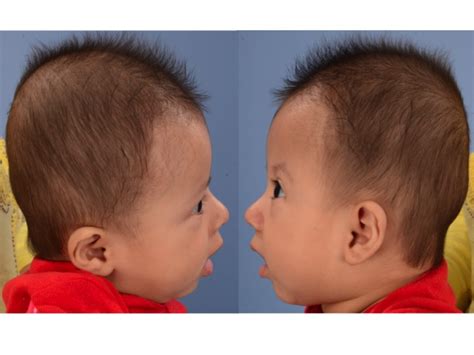 coronal synostosis dallas pediatric plastic surgeon craniofacial