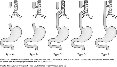 Oesophageal Atresia With No Distal Tracheoesophageal Fistula