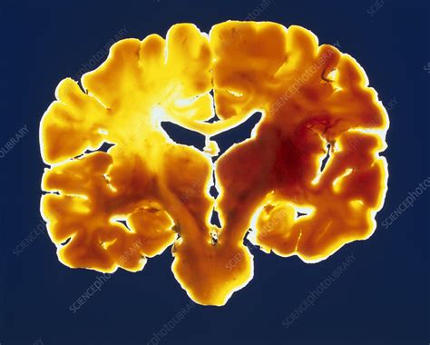coronal slice   healthy human brain stock image p