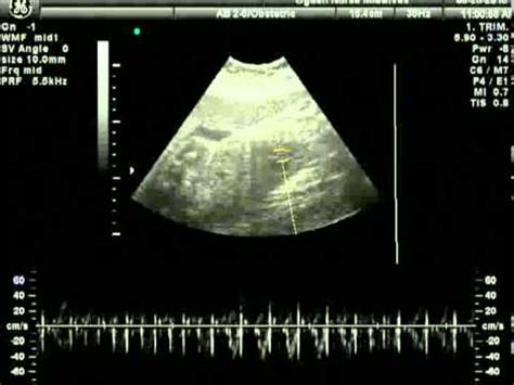 sixth sonogram youtube