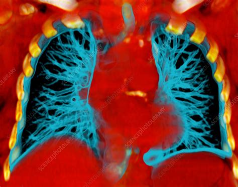 Healthy Lungs Ct Scan Stock Image C021 7940 Science Photo Library