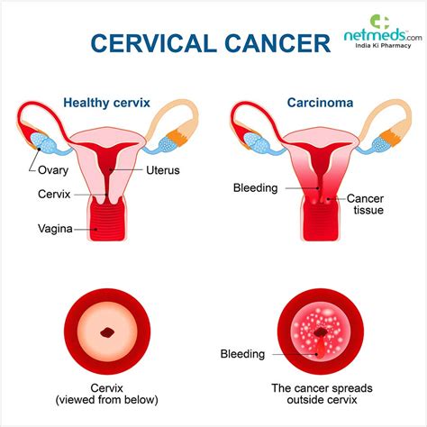 cervical cancer  symptoms  treatment netmeds