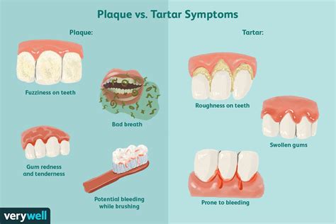plaque vs tartar buildup removal and dental hygiene tips