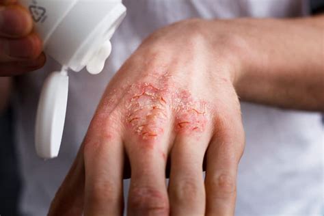treatment  home remedies  eczema