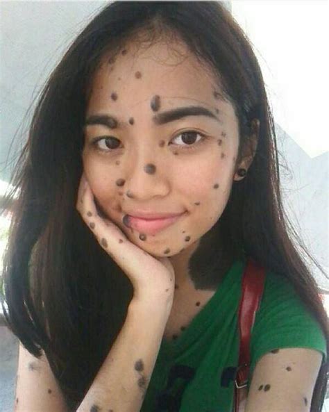 Woman Relentlessly Bullied For Mole Covered Face And Cruelly Branded A