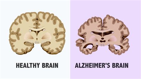 stages  alzheimer   effects circlecare