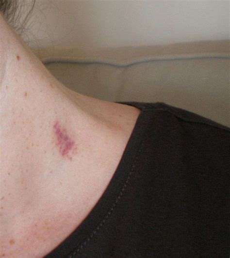 how to remove kiss mark on neck quickly howto techno