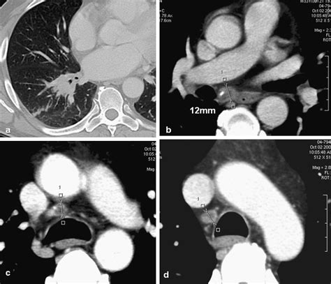Msct Multi Criteria A Novel Approach In Assessment Of Mediastinal