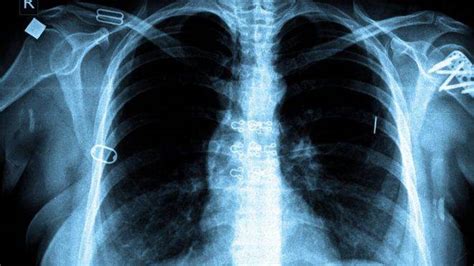 tuberculosis  nepal prevention diagnosis medicines symptoms