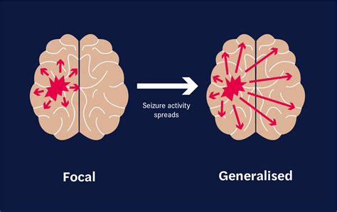 focal onset seizures seer medical au