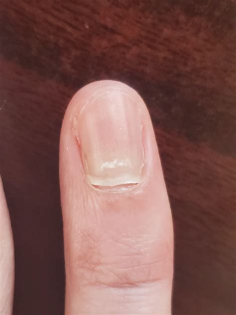 fingernail   fall  medical