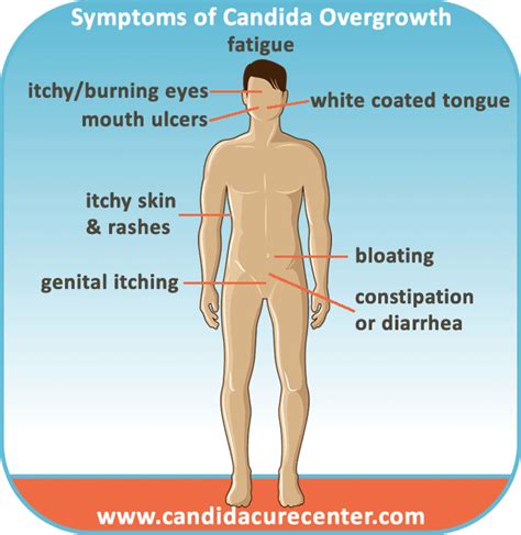 Symptoms Of Candida Albicans Overgrowth Signs Of Candida