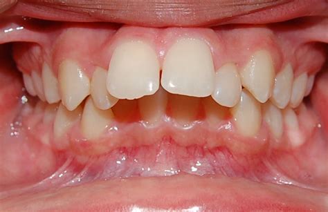 protrusion    braces pictures mccormick orthodontics