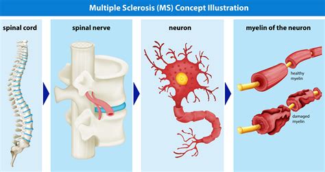 diagram showing multiple sclerosis concept  vector art  vecteezy