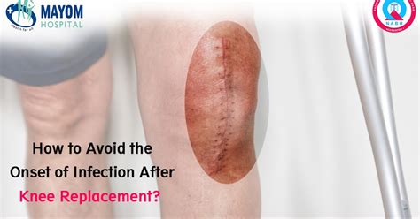 How To Avoid The Onset Of Infection After Knee Replacement