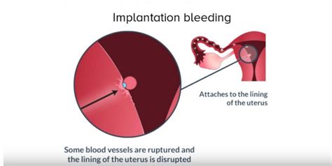 implantation bleeding signs symptoms causes and facts you need to know