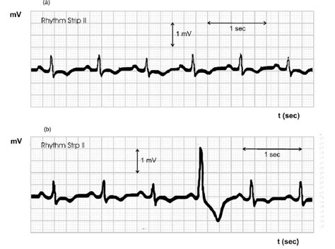 A Normal Ecg Signal For A Healthy Heart Of A 22 Year Old Man B Ecg