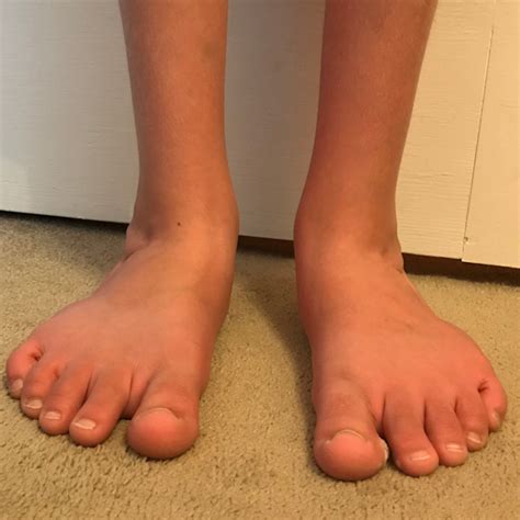 flat feet  children care  feet