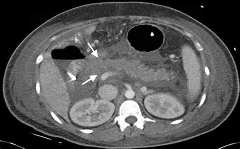 Cureus Solid Pseudopapillary Tumor Of The Pancreas In A Patient With