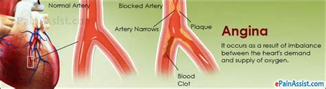 anginatypescausessymptomstreatment beta calcium channel blockers surgery
