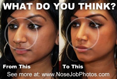 139 best plastic surgery before and after images on pinterest