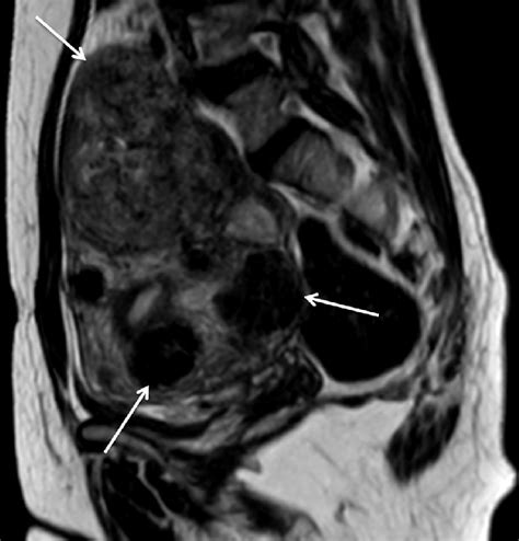 sagittal t2 weighted mri shows multiple uterine fibroids affecting