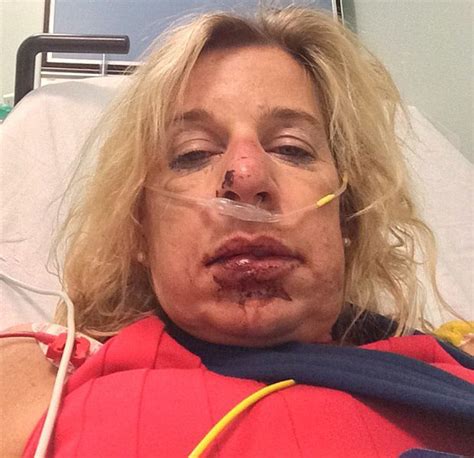 Katie Hopkins Smashes Her Face Cbb Star In Ambulance Dash