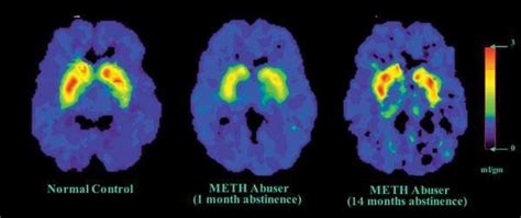 Meth Brain Harm Cut By Medicinova Drug The San Diego