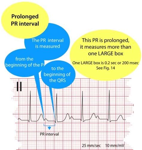 electrocardiogram prolonged pr interval figure  electrocardiogram  scientific
