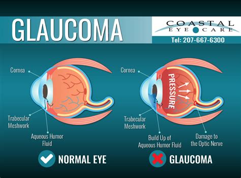 Glaucoma Diagnosis And Treatment For Bangor Me – Coastal Eye Care
