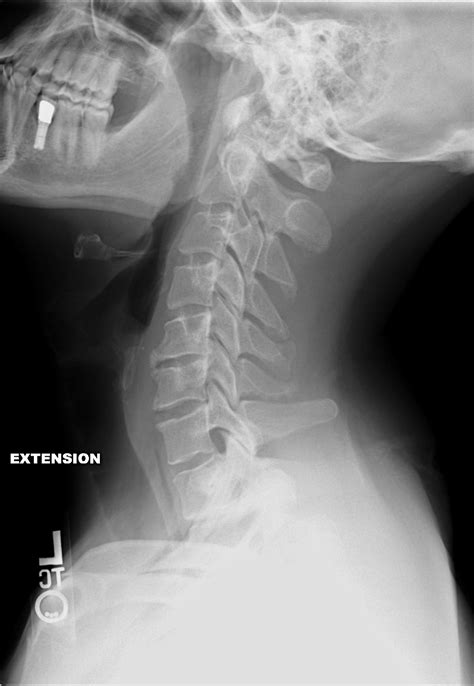 file cervical xray extension wikimedia commons